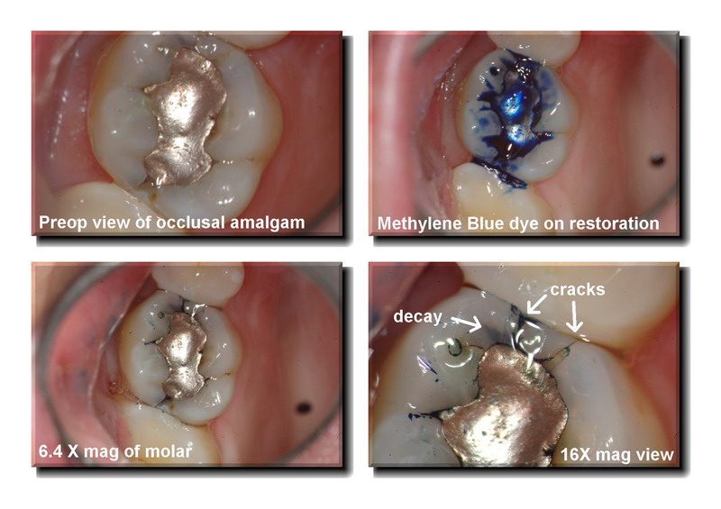 Cracked tooth pg 1 edited_resize.jpg